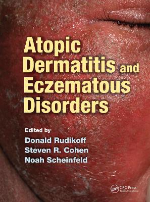 Atopic Dermatitis and Eczematous Disorders Cover